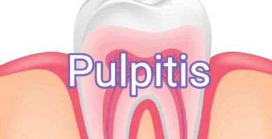 pulpitis