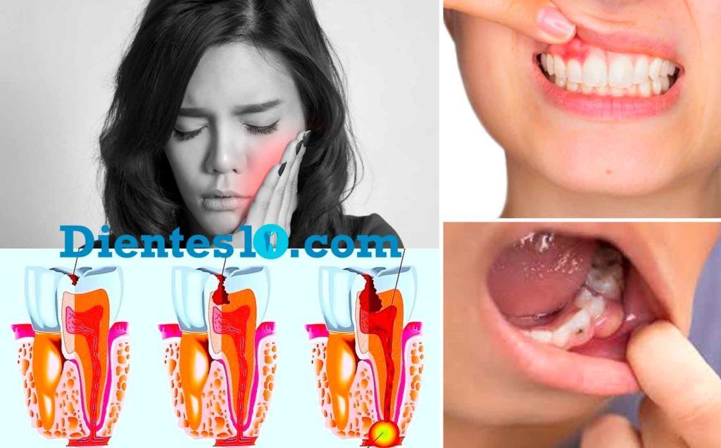 tratamiento-absceso-dental