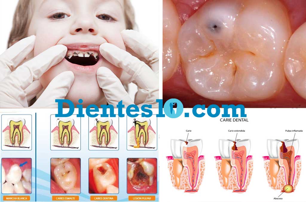 caries-dental-ninos