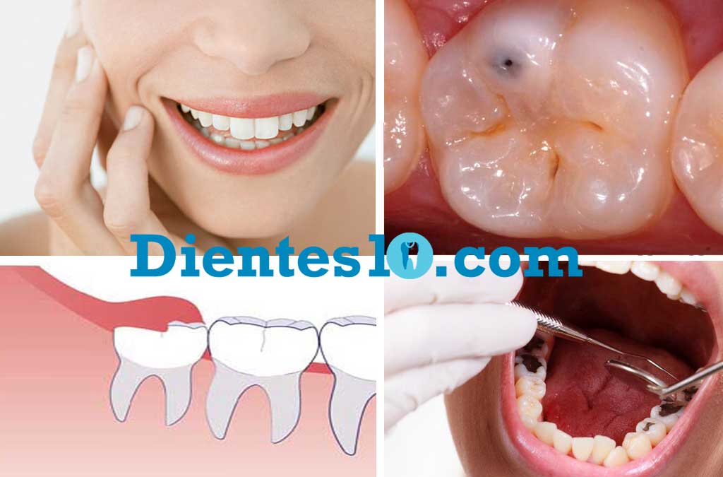 caries-dental-sintomas