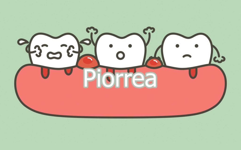 piorrea