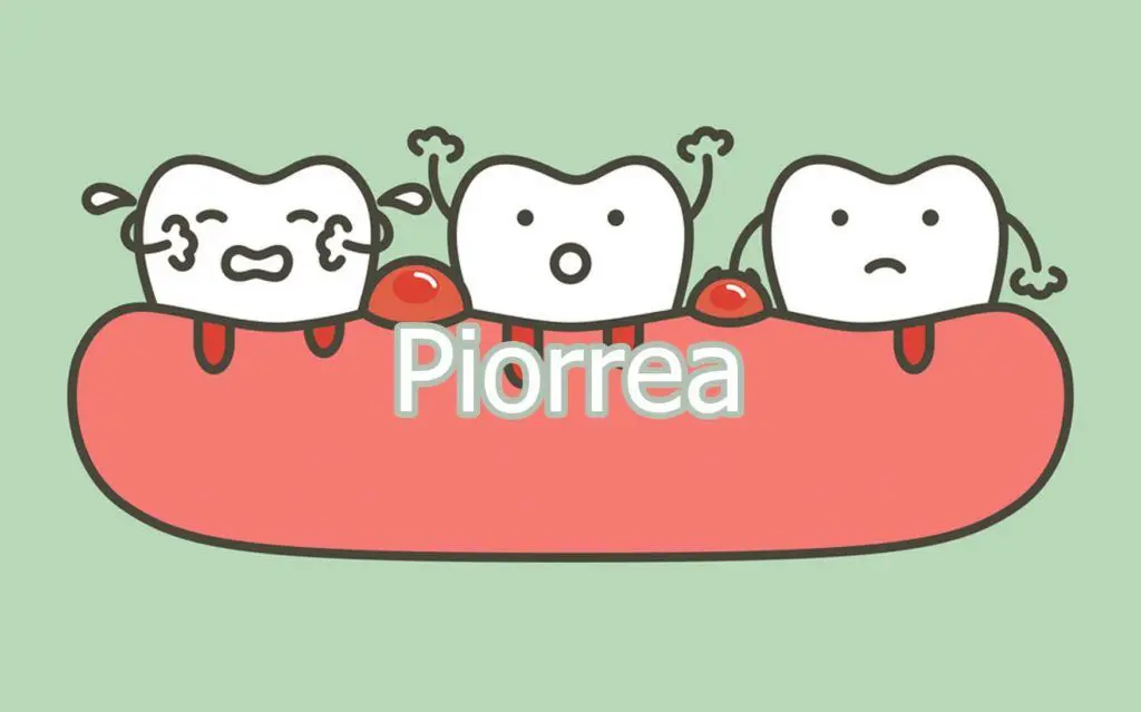 Piorrea 1 piorrea