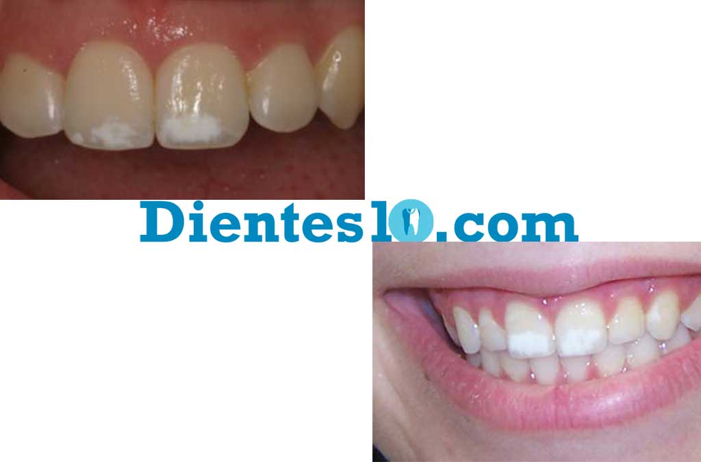 Manchas-en-los-Dientes