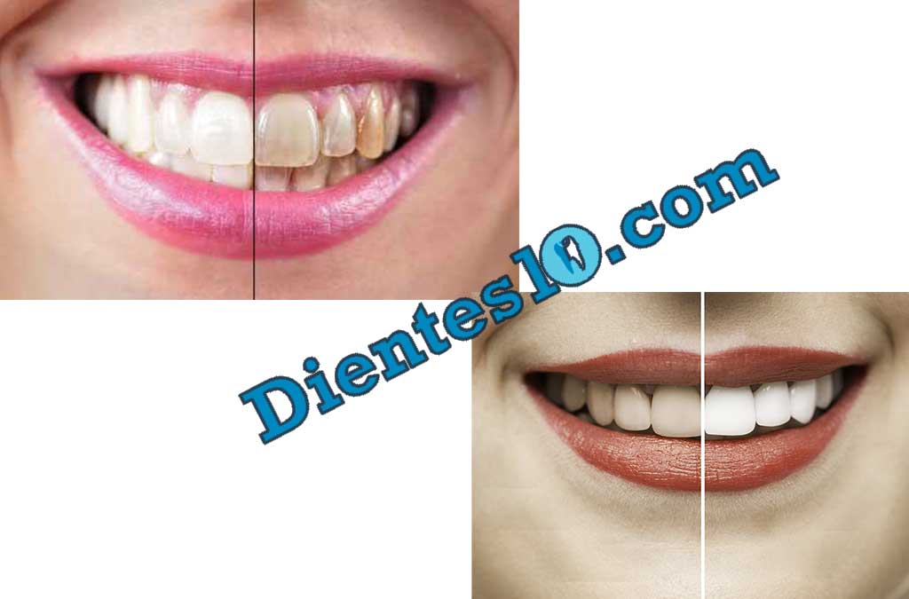 blanqueamiento-dental-antes-y-despues