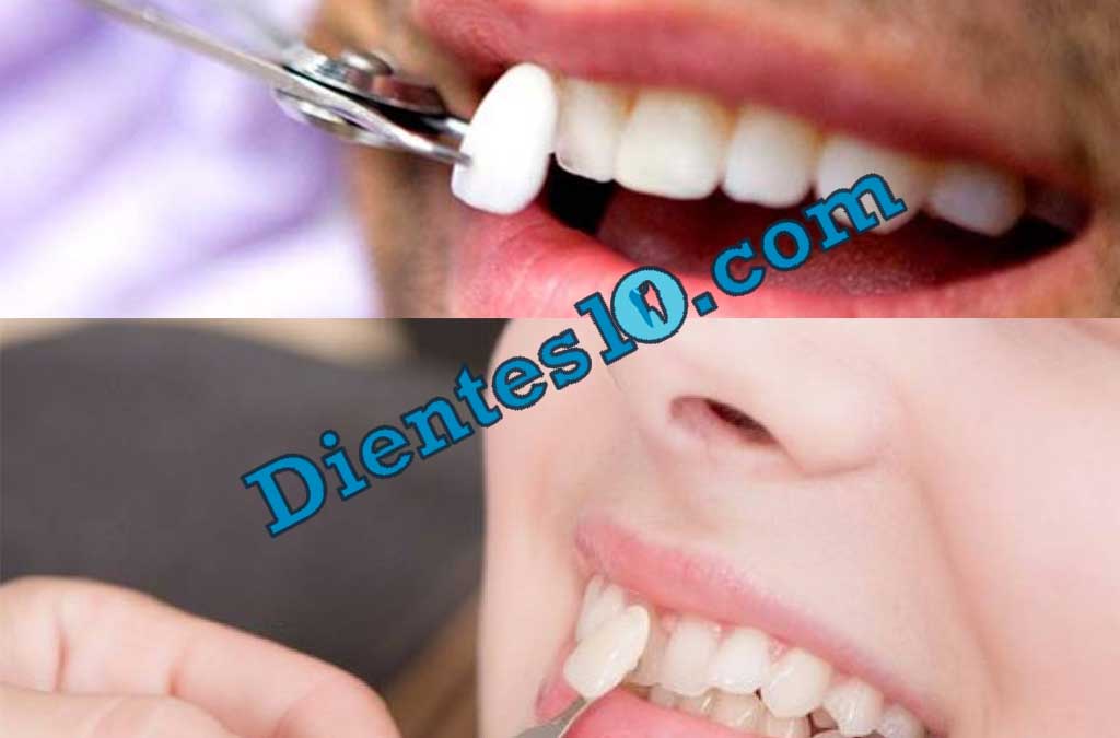 carillas-dentales