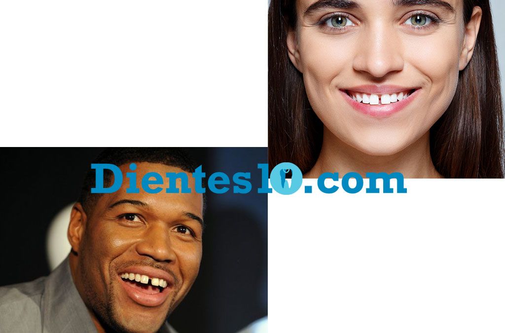 diastema-dental