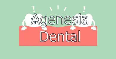 agenesia-dental