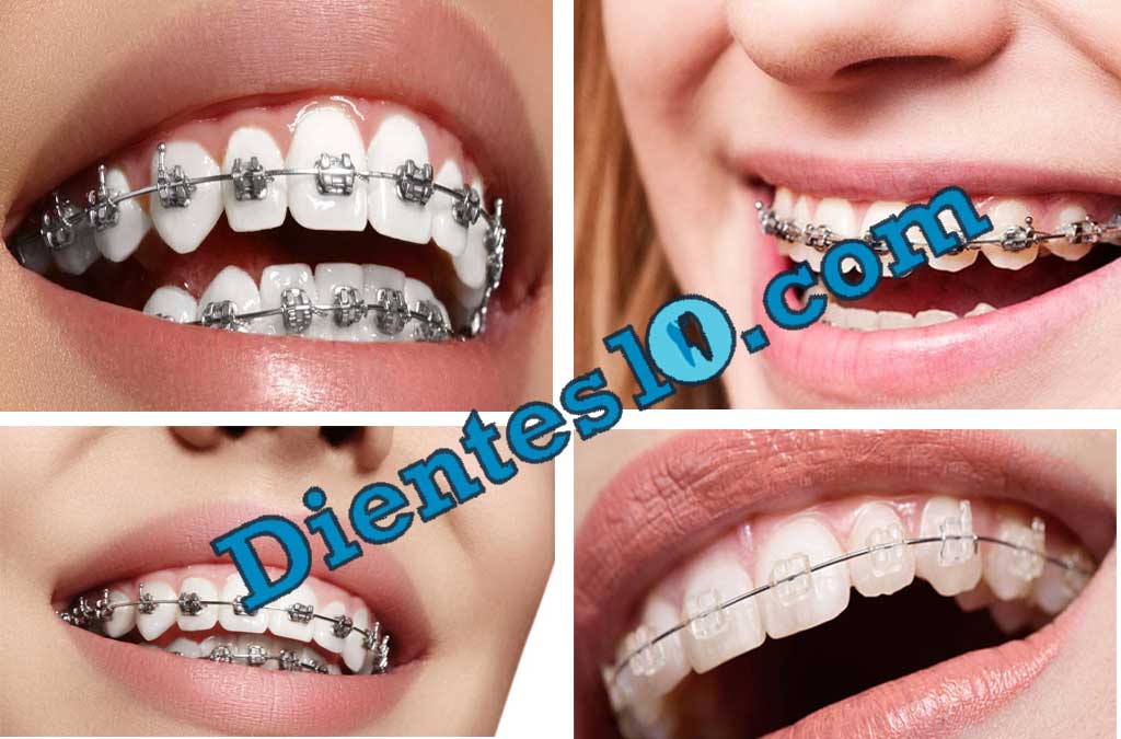 brackets-