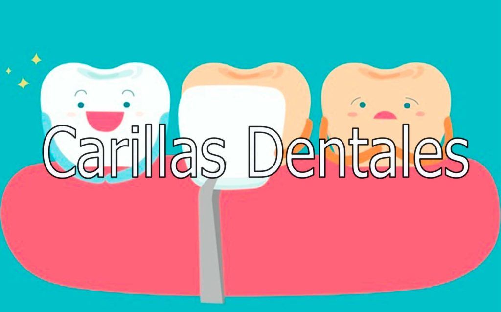 carillas-dentales