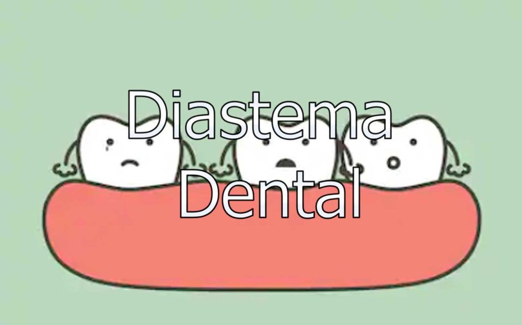 diastema-dental