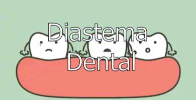 diastema-dental