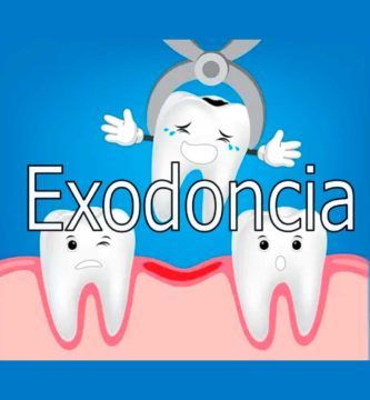 exodoncia