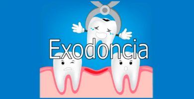 exodoncia