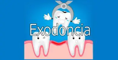 exodoncia