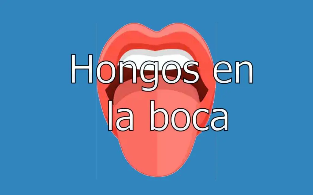 Candidiasis en la Boca 1 candidiasis-en-la-boca