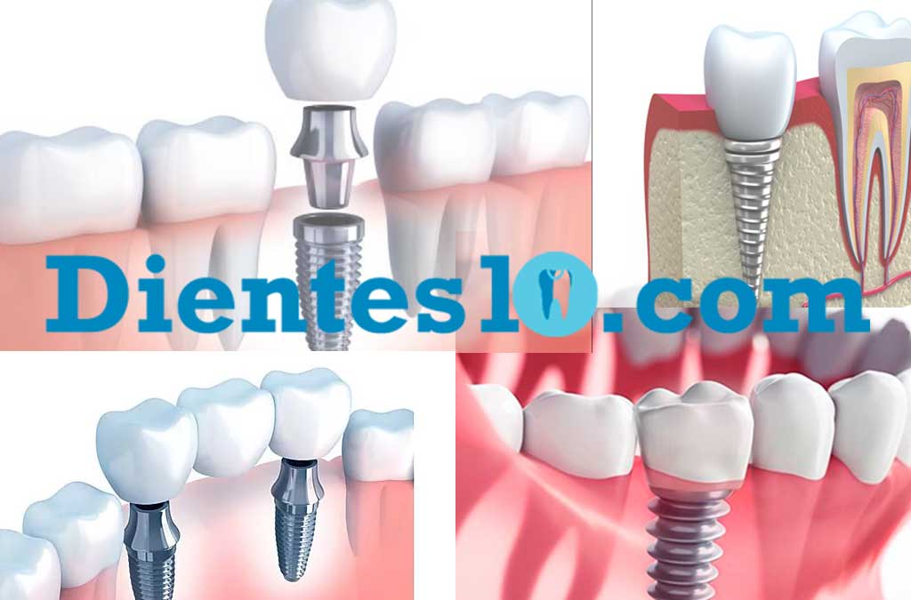 implantes-dentales