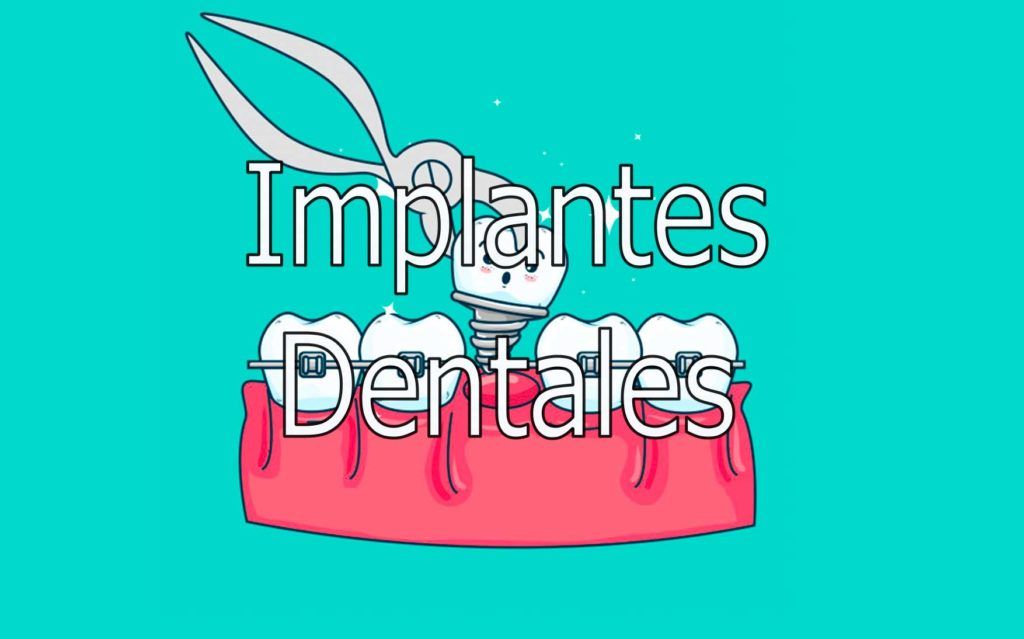 implantes-dentales