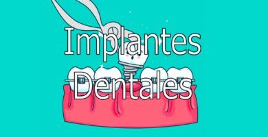 implantes-dentales