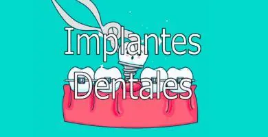 implantes-dentales