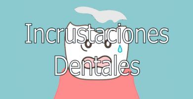 incrustaciones-dentales