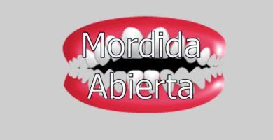 mordida-abierta