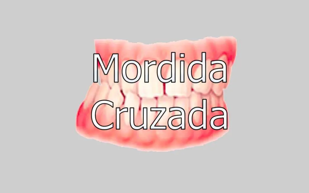 Mordida Cruzada 1 mordida-cruzada