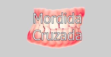 mordida-cruzada