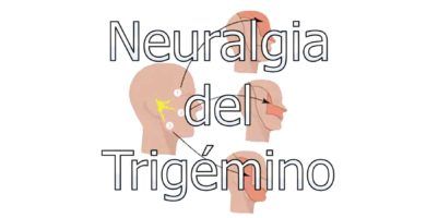 neuralgia-del-trigemino