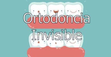 ortodoncia-invisible