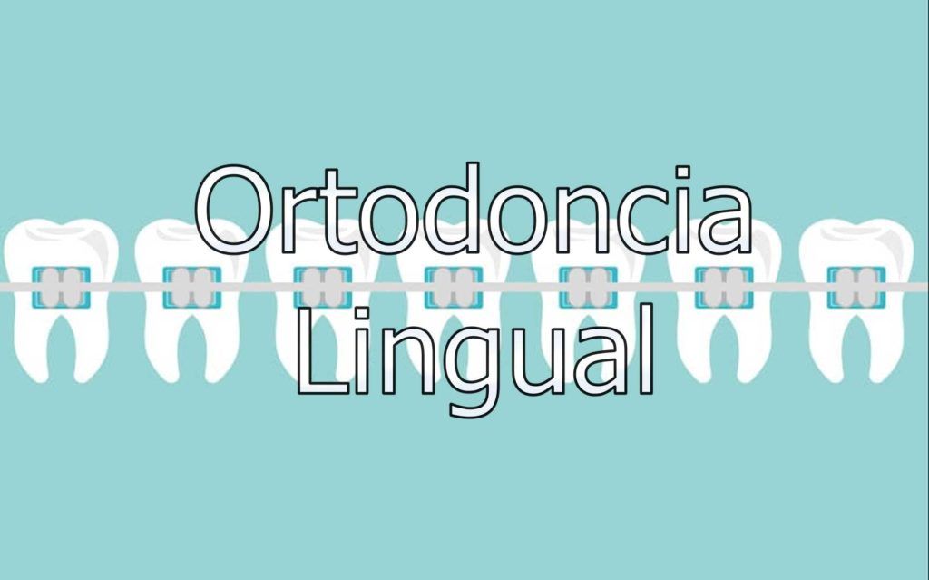 ortodoncia-lingual