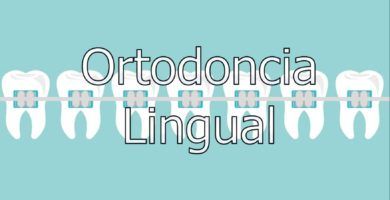 ortodoncia-lingual