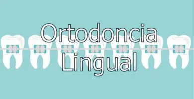 ortodoncia-lingual