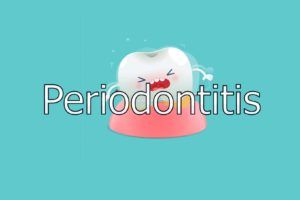 Periodontitis 2