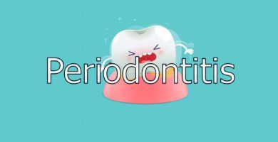 Periodontitis 1