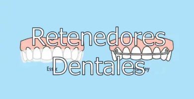 retenedores-dentales