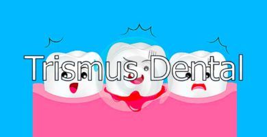 trismus-dental