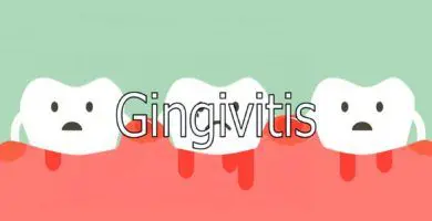 gingivitis