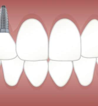 implantes-dentales