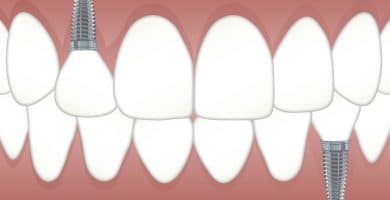 implantes-dentales