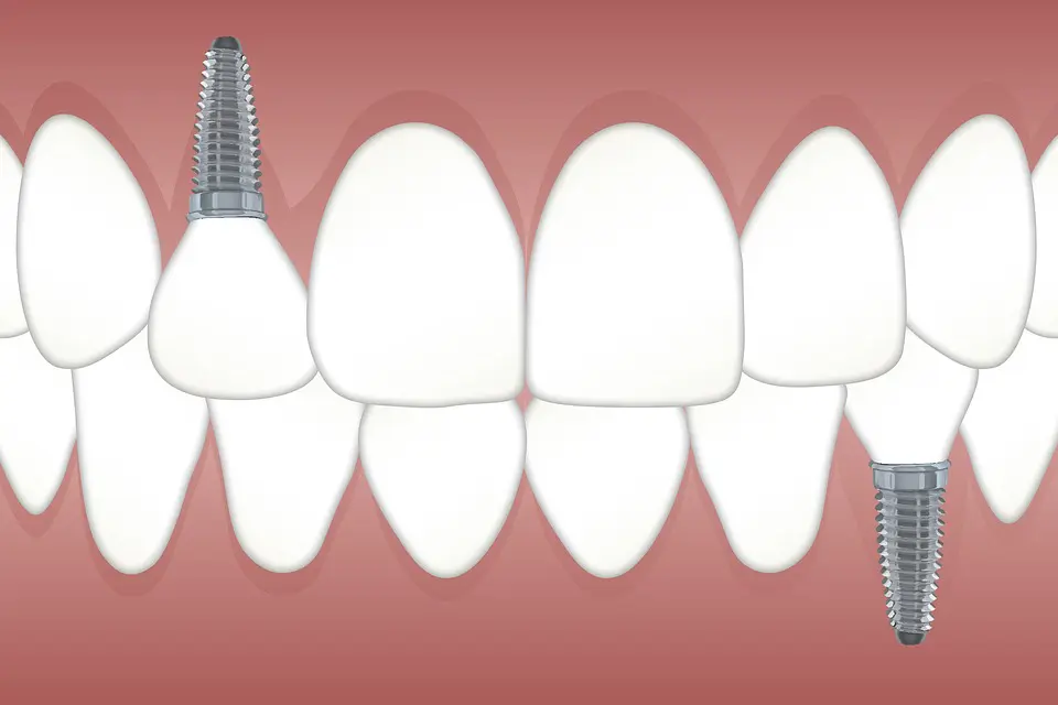 Beneficios de los implantes dentales que debes conocer 1 implantes-dentales